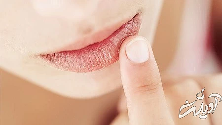 از نشانه های کم خونی رنگ پریدگی لب ها و لثه ها نشانه های کمبود مواد مغذی در صورت, چشم های پف کرده